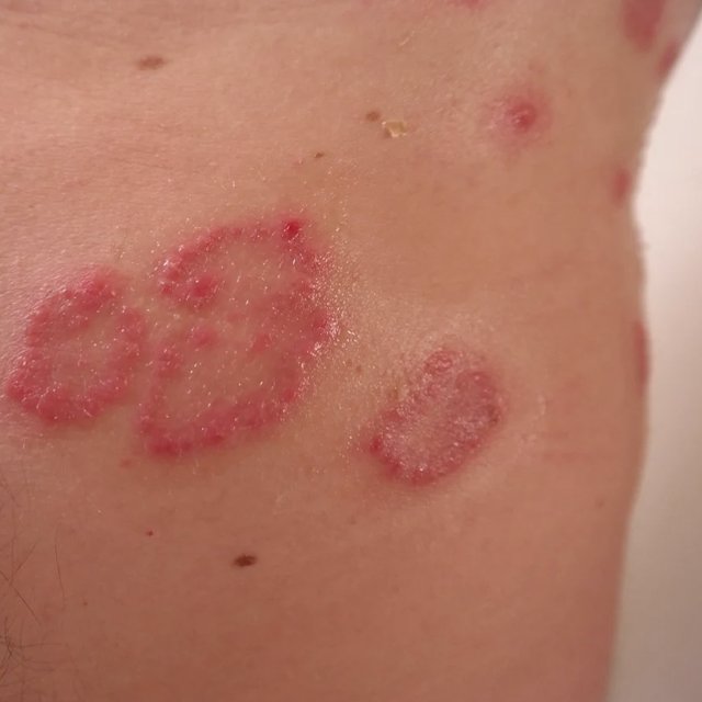 A question from a customer: chronic urticaria in an adult and Transfer Factor supplementation.